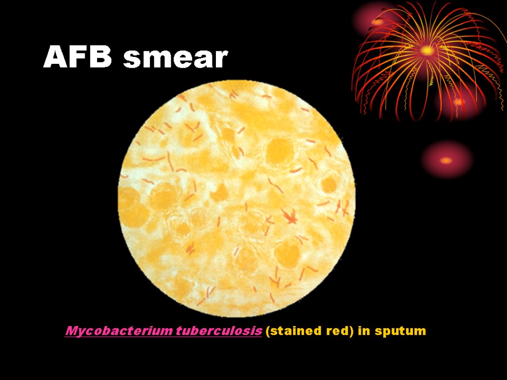 AFB smear Mycobacterium tuberculosis (stained red) in sputum